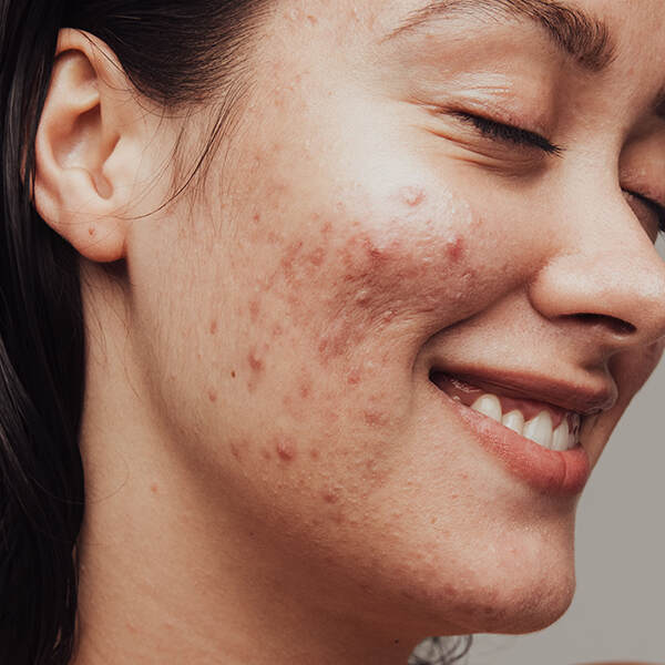 Person with acne on face